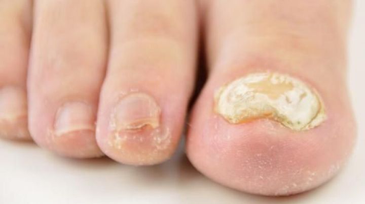 Erradica los hongos de las uñas del pie con estos 7 remedios caseros que curan la onicomicosis