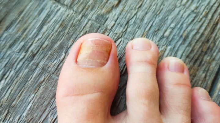 Cómo curar los hongos de los pies con remedios naturales: 6 ideas que funcionan