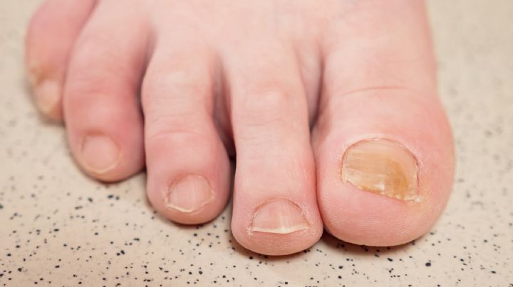 Despídete de las uñas amarillas con estos 2 remedios naturales