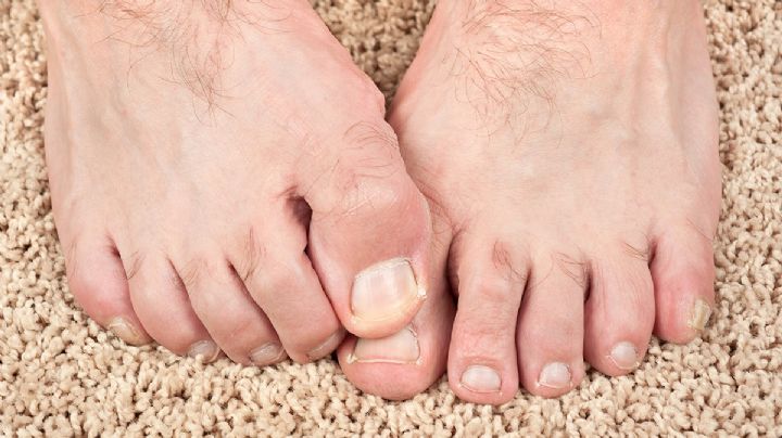 Remedios naturales para tratar los hongos en los pies: 6 ideas efectivas