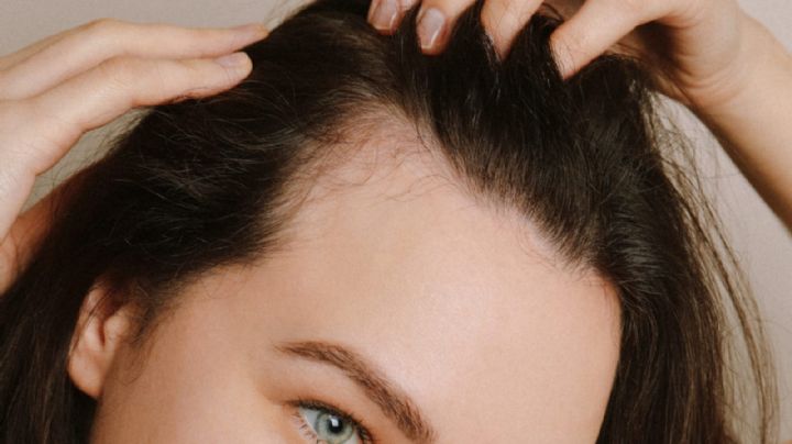 Caída de cabello: síntomas de la alopecia