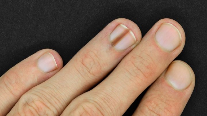 Cuidado de las uñas: Si ves esta marca sobre ellas, consulta a un especialista de inmediato