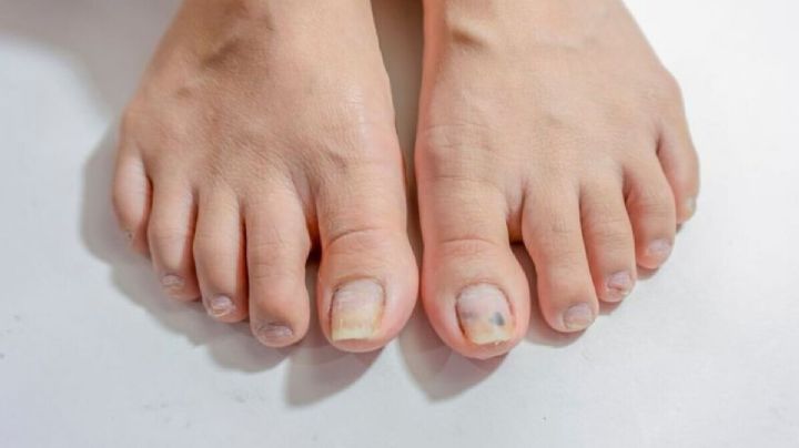 Compartió el remedio casero para eliminar los hongos en las uñas de los pies y se volvió viral